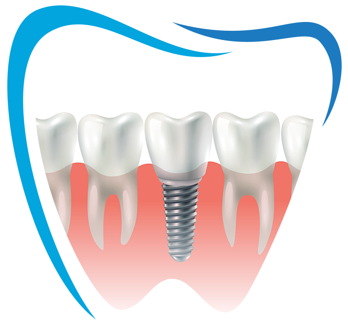 Dental Implant Clinic In Kavadiguda